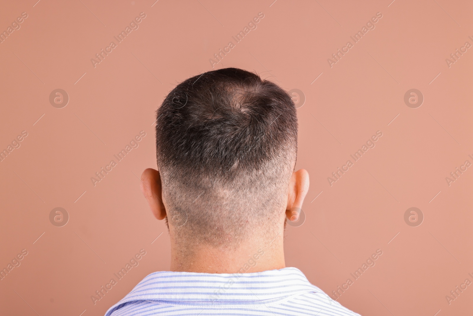 Photo of Baldness problem. Man with bald spot on dark beige background, back view