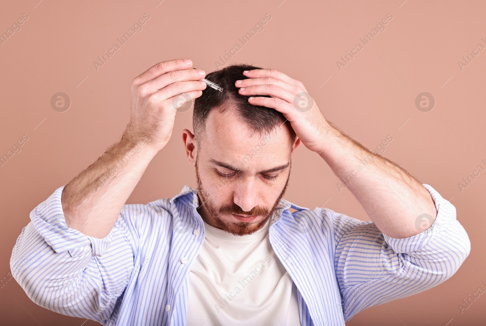 Photo of Baldness problem. Man applying serum onto hairline on dark beige background