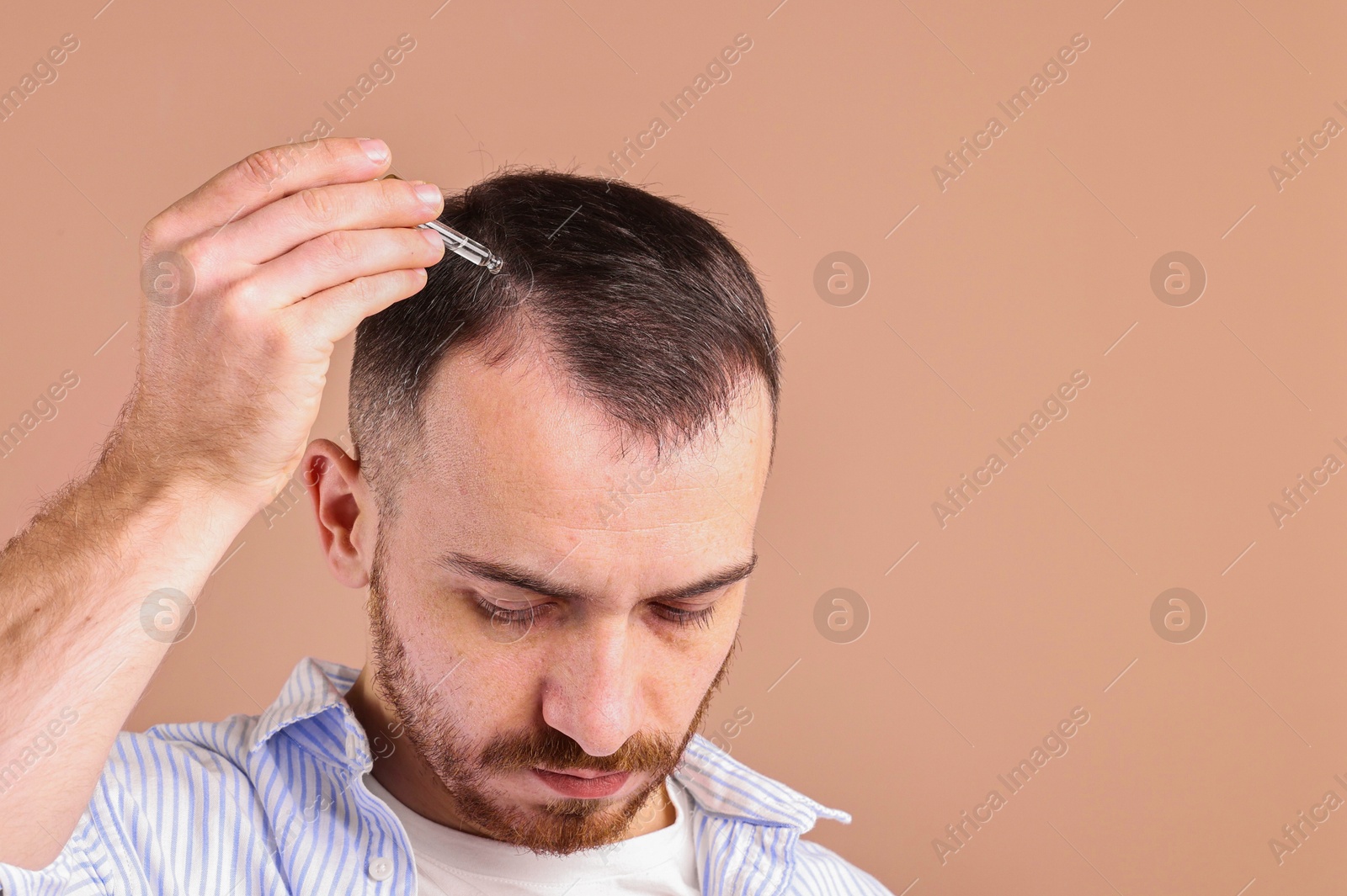 Photo of Baldness problem. Man applying serum onto hairline on dark beige background, space for text