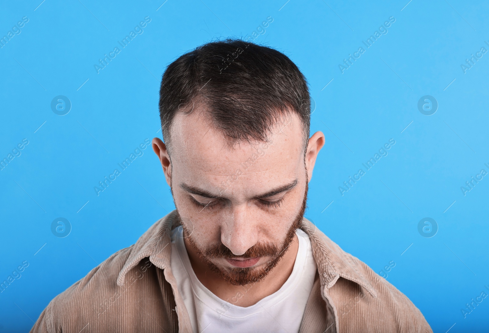 Photo of Baldness problem. Man with receding hairline on light blue background