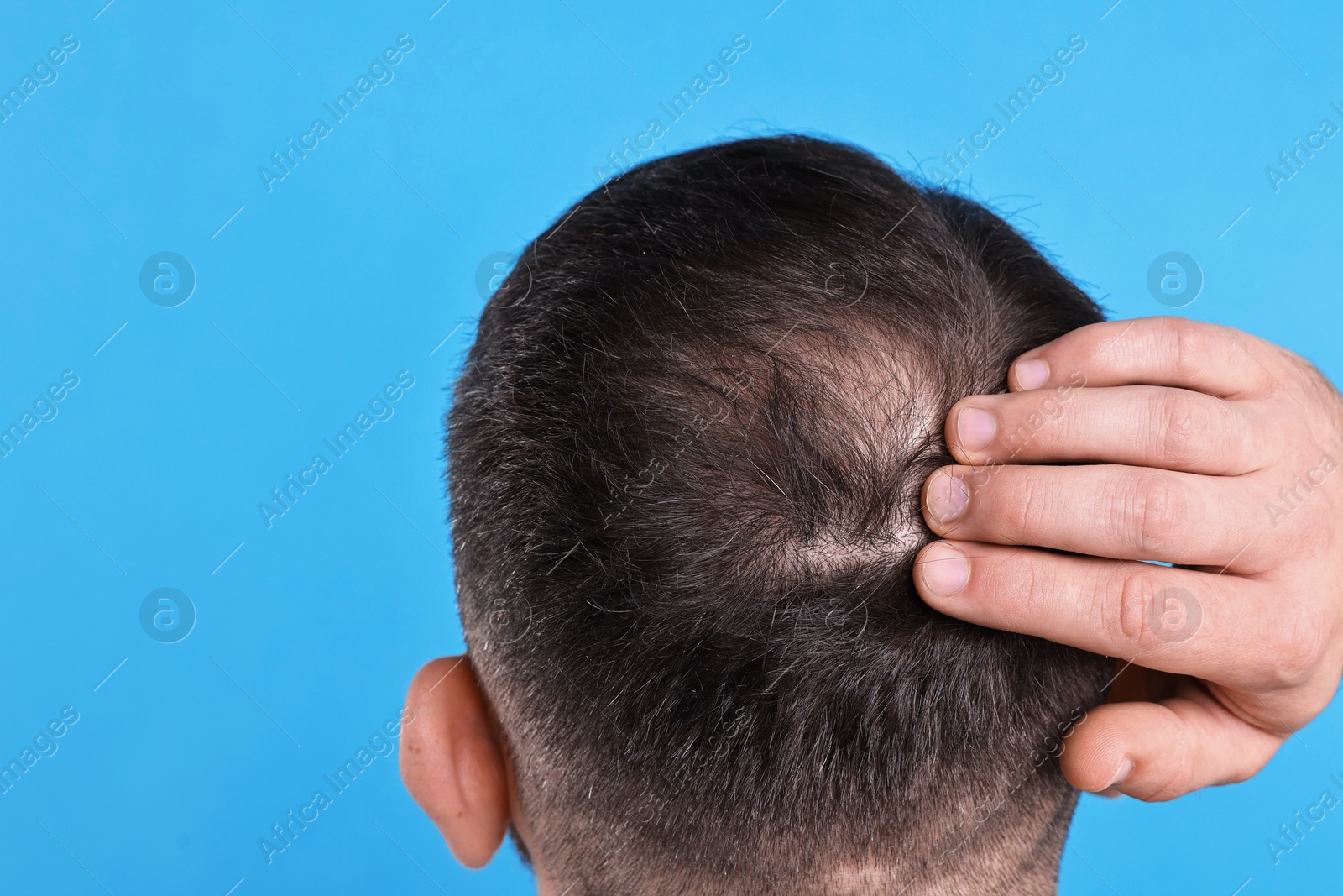 Photo of Baldness problem. Man with bald spot on light blue background, back view. Space for text