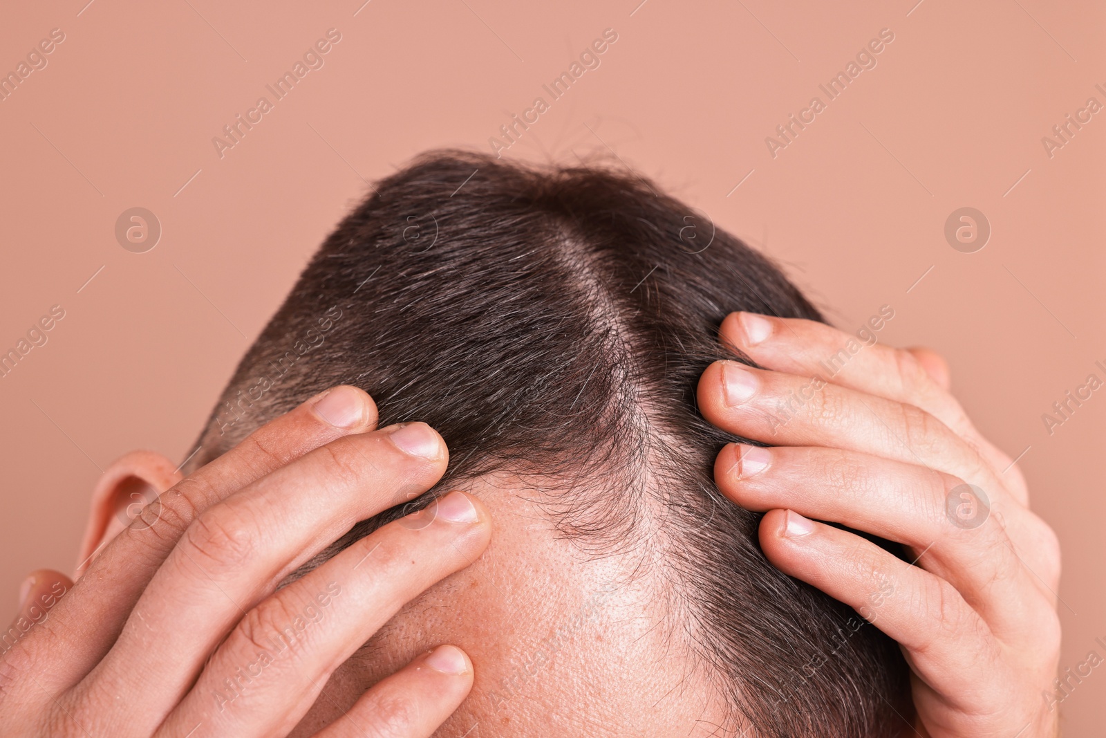 Photo of Baldness problem. Man with receding hairline on dark beige background, closeup