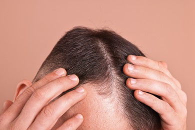 Baldness problem. Man with receding hairline on dark beige background, closeup