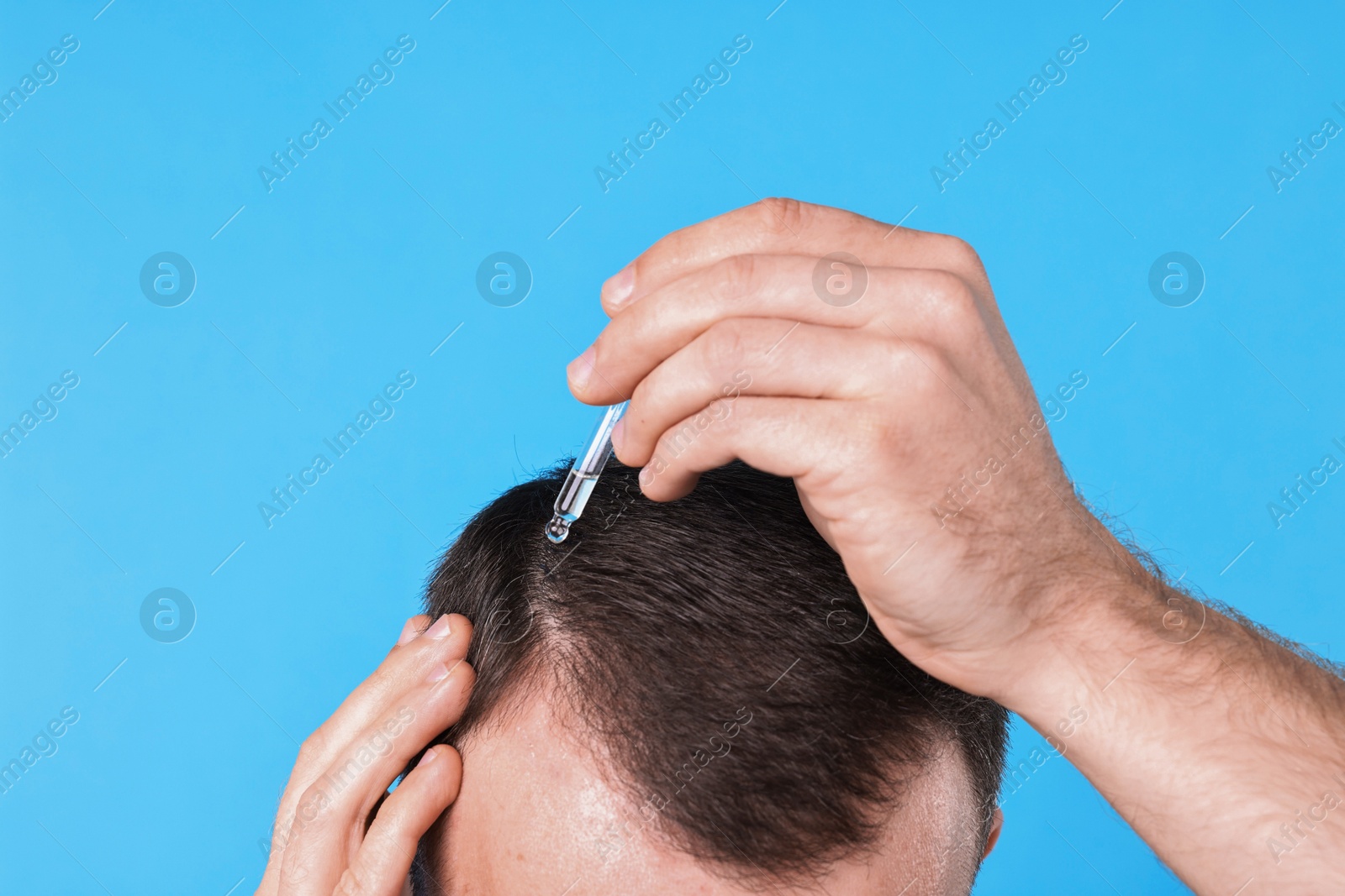 Photo of Baldness problem. Man applying serum onto hairline on light blue background, closeup