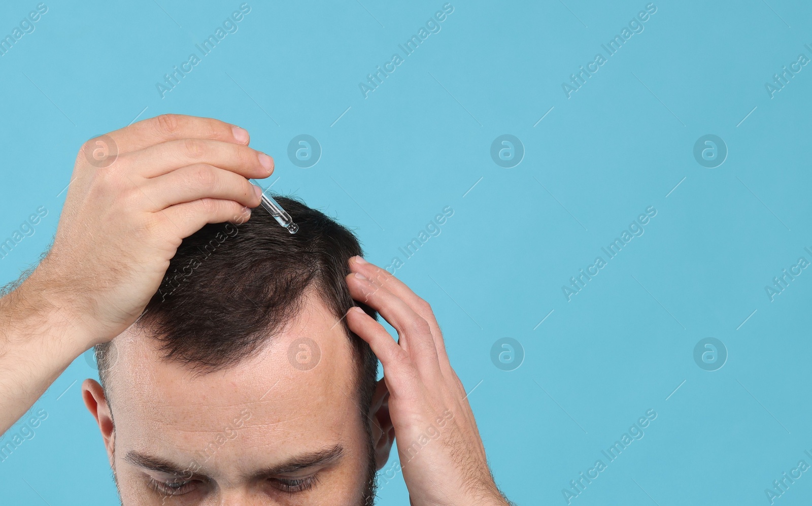 Photo of Baldness treatment. Man applying serum onto hair on light blue background, closeup. Space for text