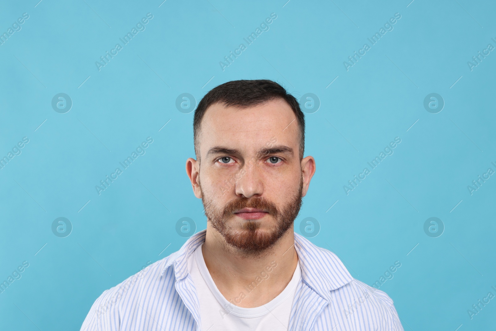 Photo of Baldness problem. Man with receding hairline on light blue background