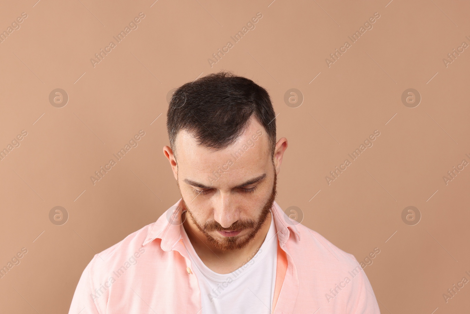 Photo of Baldness problem. Man with receding hairline on beige background