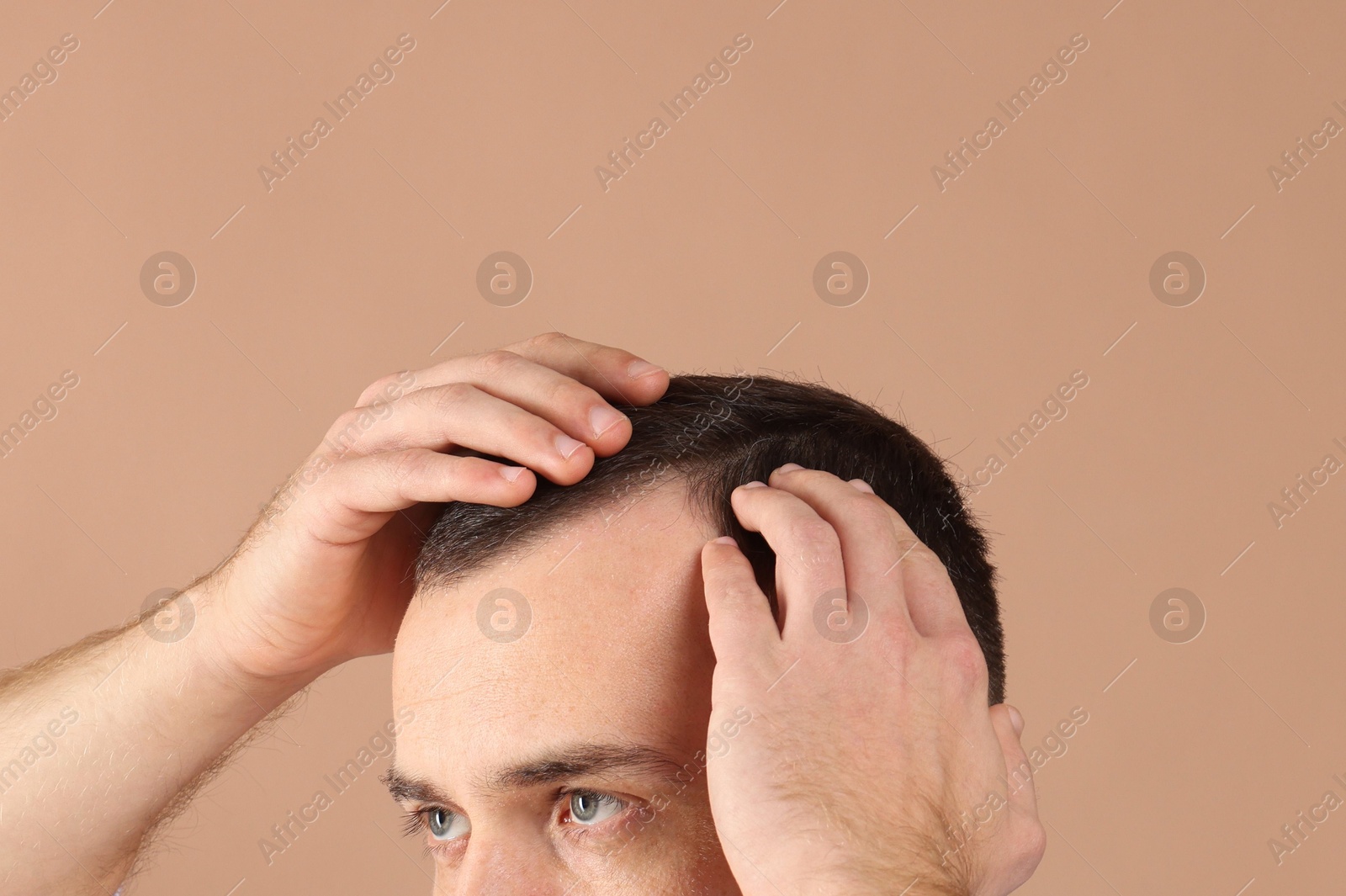 Photo of Baldness problem. Man with receding hairline on beige background, closeup