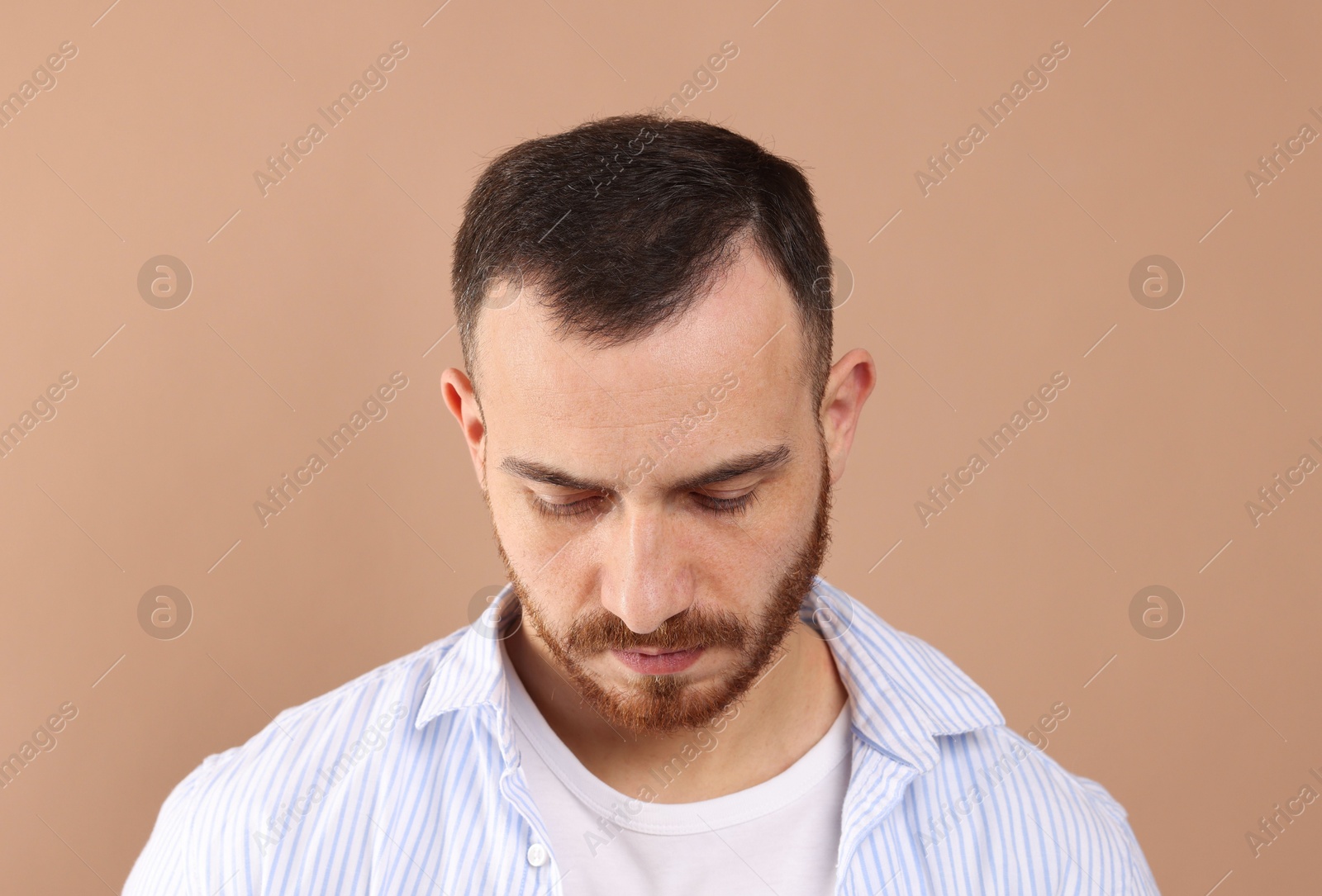 Photo of Baldness problem. Man with receding hairline on beige background