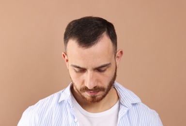 Baldness problem. Man with receding hairline on beige background