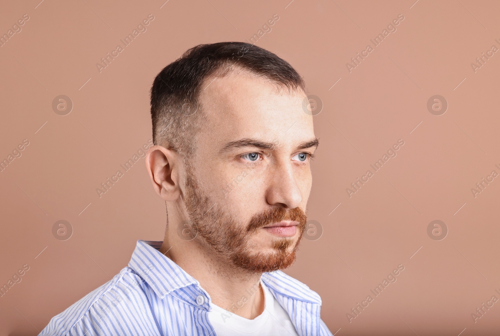 Photo of Baldness problem. Man with receding hairline on dark beige background, space for text