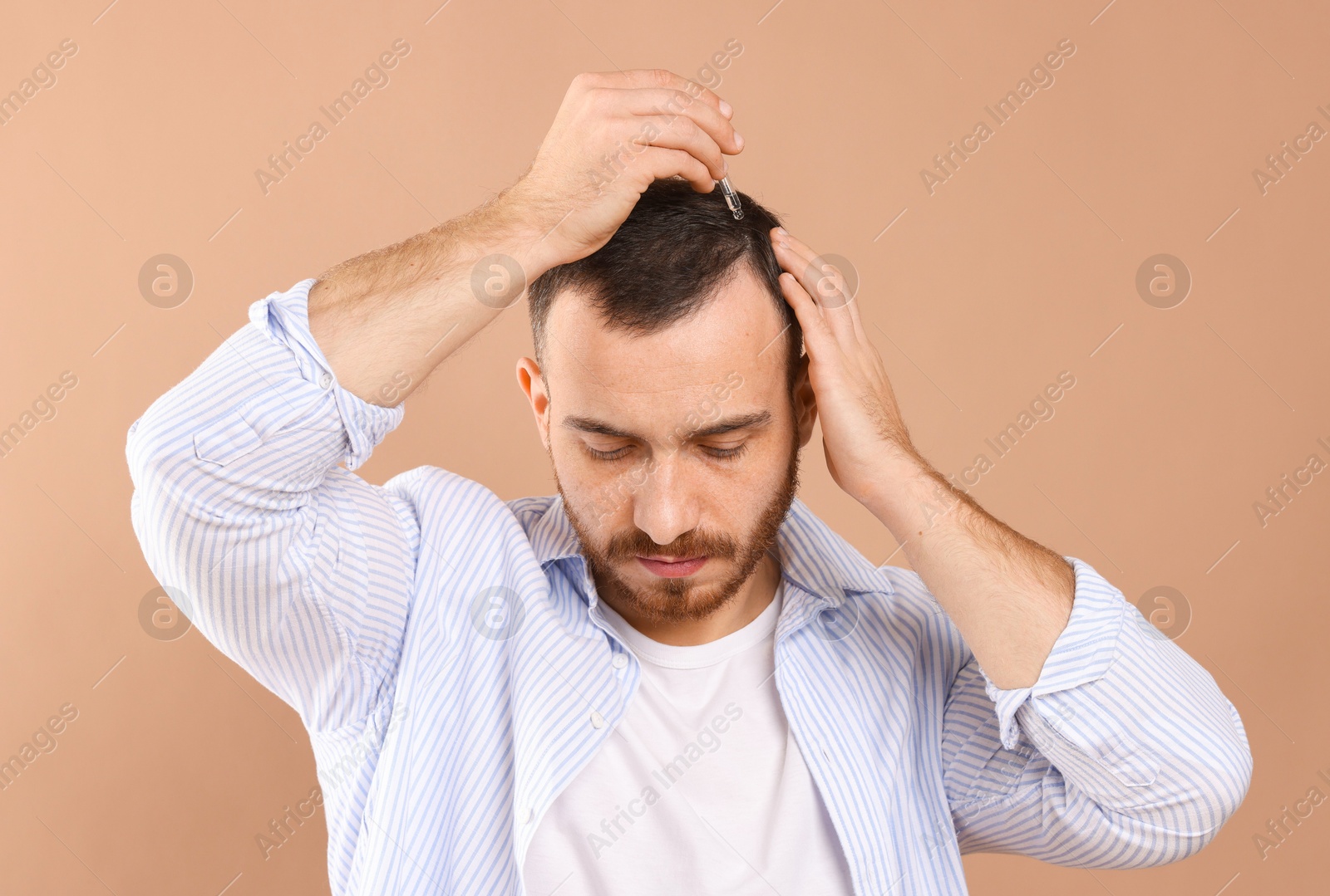 Photo of Baldness treatment. Man applying serum onto hair on beige background