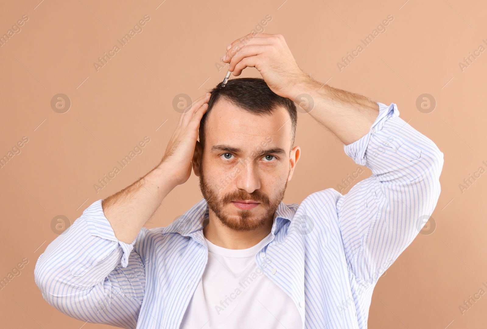 Photo of Baldness treatment. Man applying serum onto hair on beige background