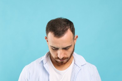 Photo of Baldness problem. Man with receding hairline on light blue background