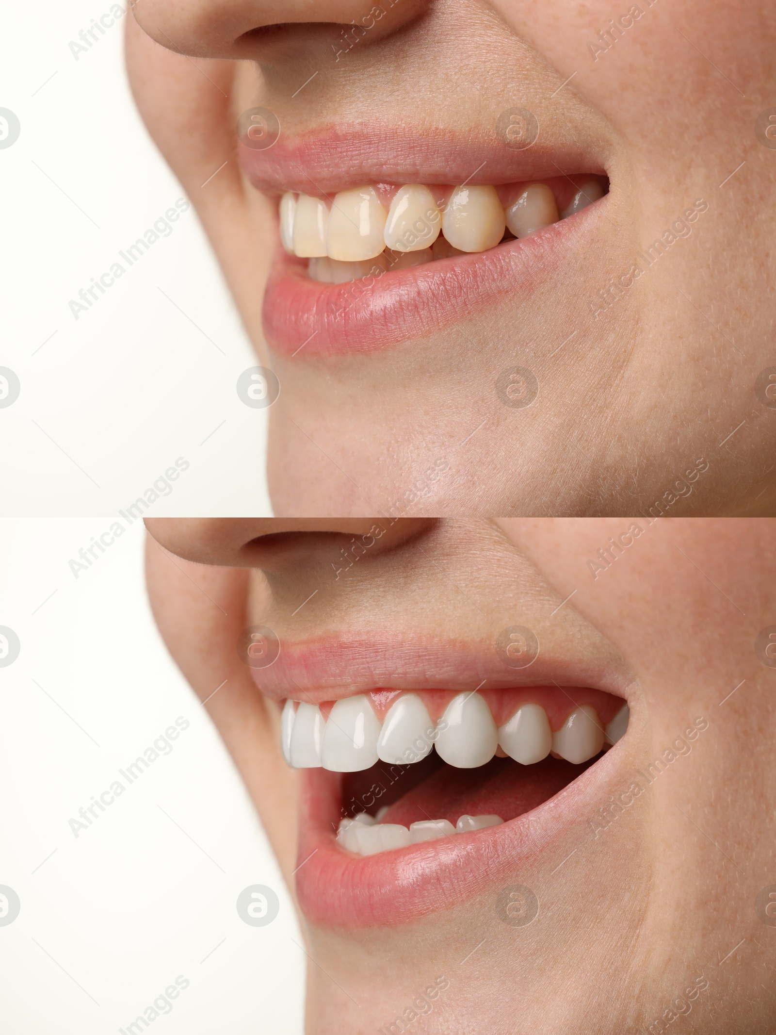 Image of Woman smiling before and after procedure dental veneers placement on white background, closeup. Aesthetic improvement of teeth, collage