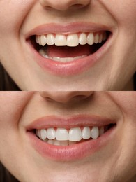 Image of Woman smiling before and after procedure dental veneers placement, closeup. Aesthetic improvement of teeth, collage