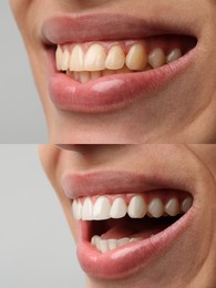 Image of Man smiling before and after procedure dental veneers placement on grey background, closeup. Aesthetic improvement of teeth, collage