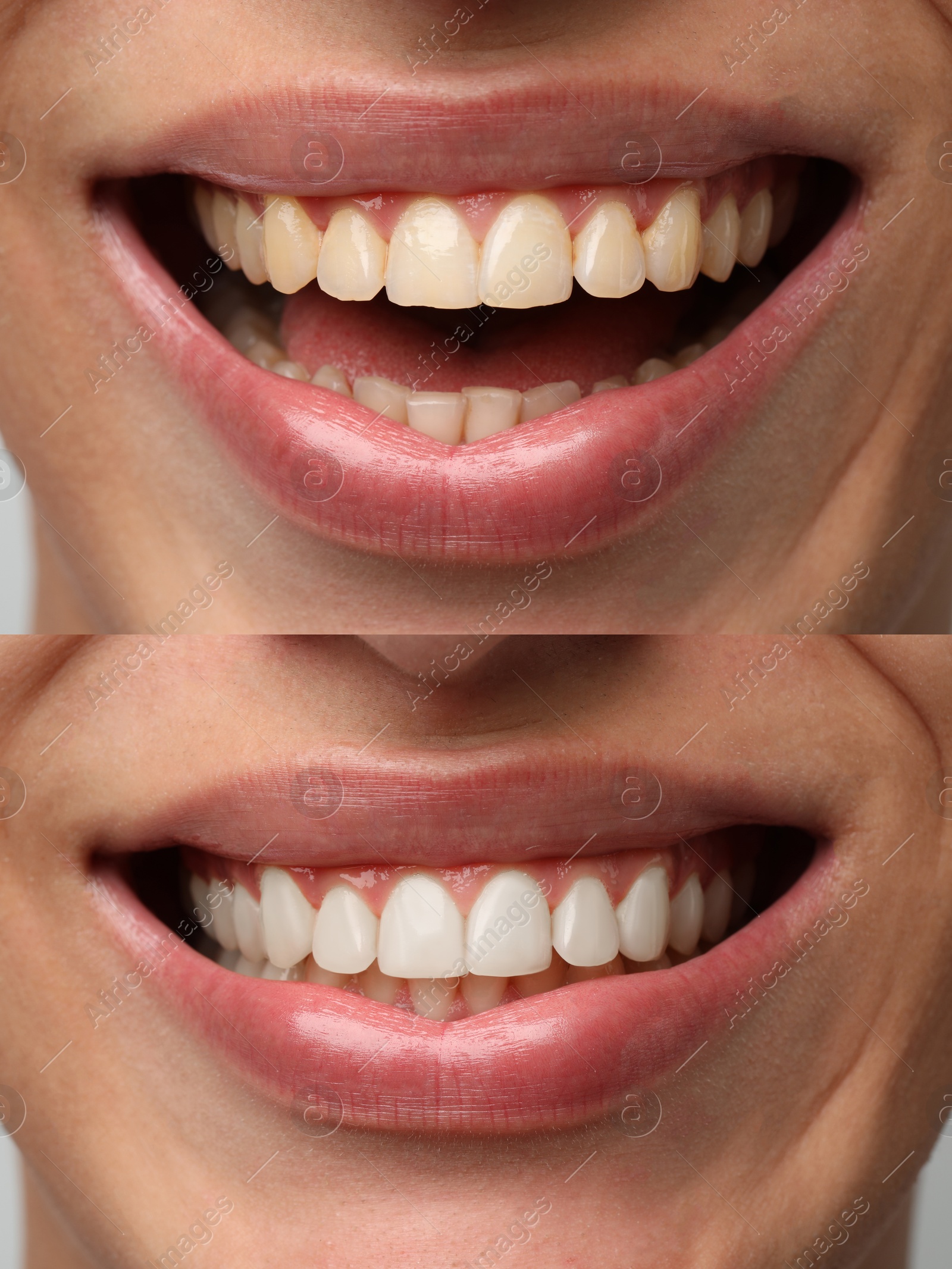 Image of Man smiling before and after procedure dental veneers placement, closeup. Aesthetic improvement of teeth, collage