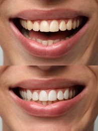 Image of Man smiling before and after procedure dental veneers placement, closeup. Aesthetic improvement of teeth, collage