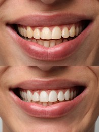 Image of Man smiling before and after procedure dental veneers placement, closeup. Aesthetic improvement of teeth, collage