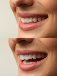 Image of Woman smiling before and after procedure dental veneers placement on light background, closeup. Aesthetic improvement of teeth, collage