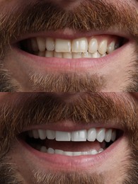 Image of Man smiling before and after procedure dental veneers placement, closeup. Aesthetic improvement of teeth, collage