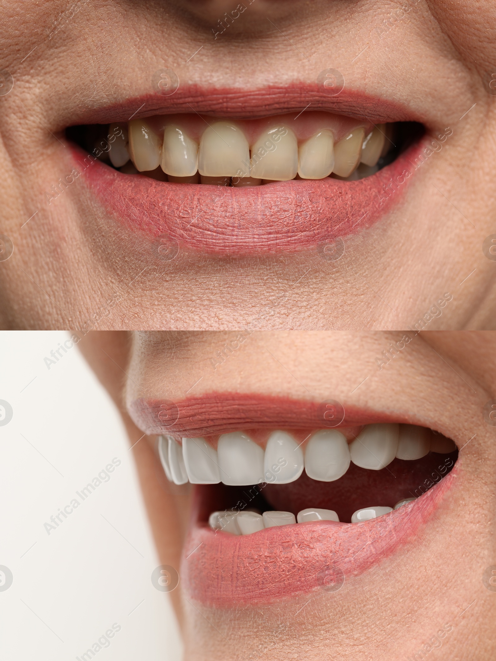 Image of Woman smiling before and after procedure dental veneers placement, closeup. Aesthetic improvement of teeth, collage