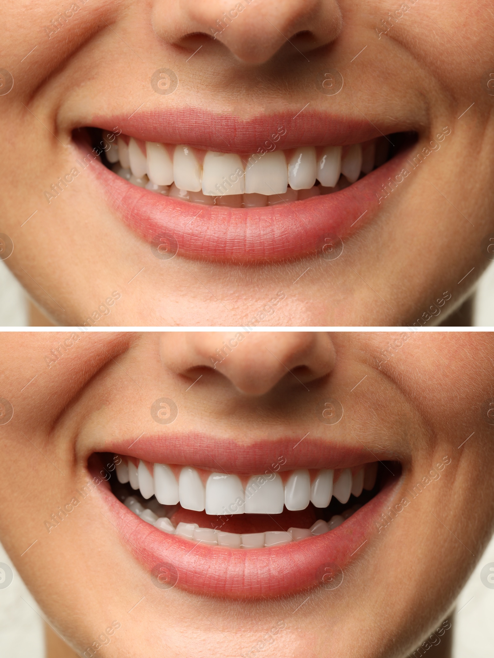 Image of Woman smiling before and after procedure dental veneers placement, closeup. Aesthetic improvement of teeth, collage