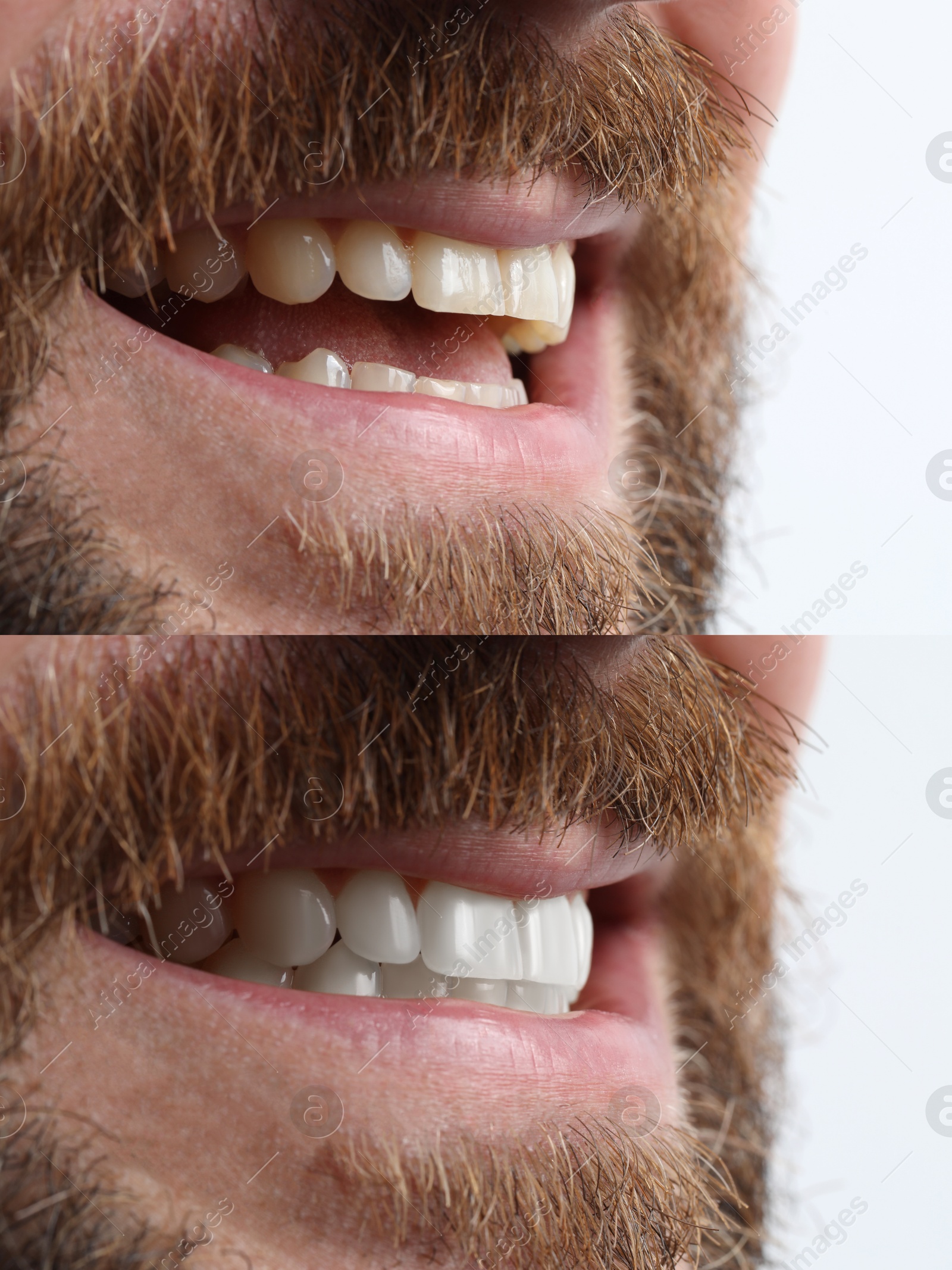 Image of Man smiling before and after procedure dental veneers placement on white background, closeup. Aesthetic improvement of teeth, collage