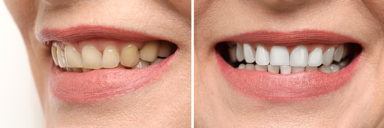 Image of Woman smiling before and after procedure dental veneers placement, closeup. Aesthetic improvement of teeth, collage