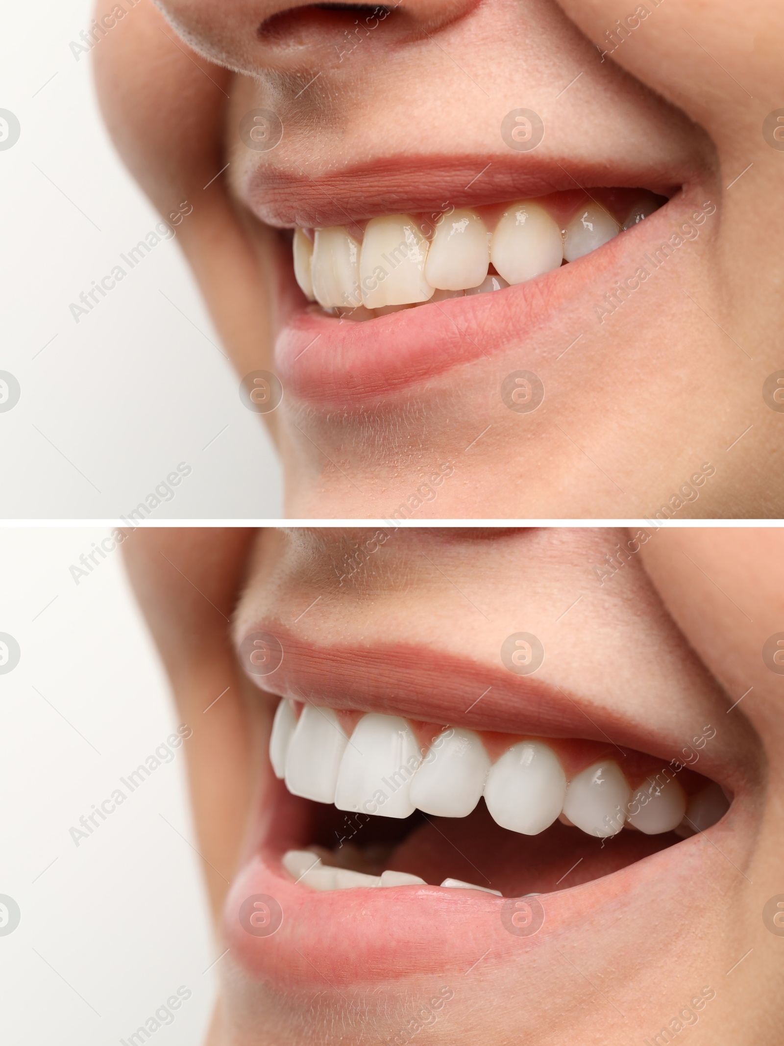 Image of Woman smiling before and after procedure dental veneers placement on white background, closeup. Aesthetic improvement of teeth, collage