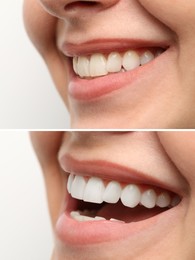 Image of Woman smiling before and after procedure dental veneers placement on white background, closeup. Aesthetic improvement of teeth, collage