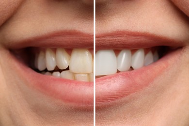 Image of Woman smiling before and after procedure dental veneers placement, closeup. Aesthetic improvement of teeth, collage