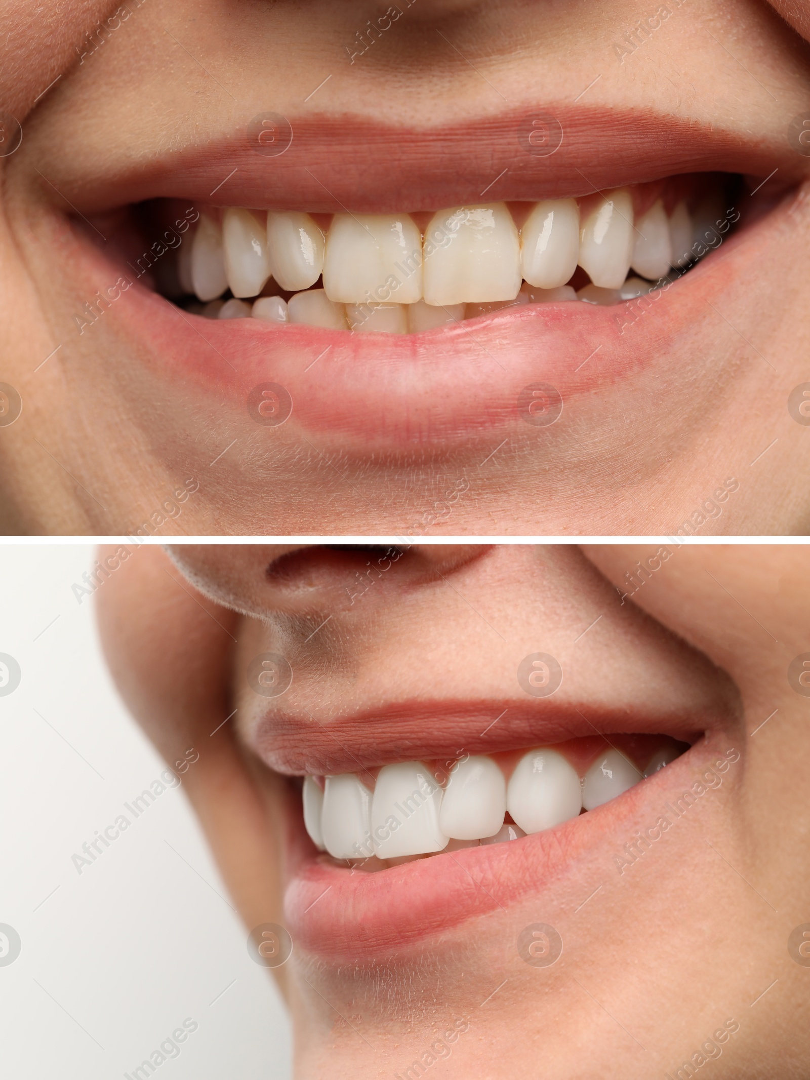 Image of Woman smiling before and after procedure dental veneers placement, closeup. Aesthetic improvement of teeth, collage