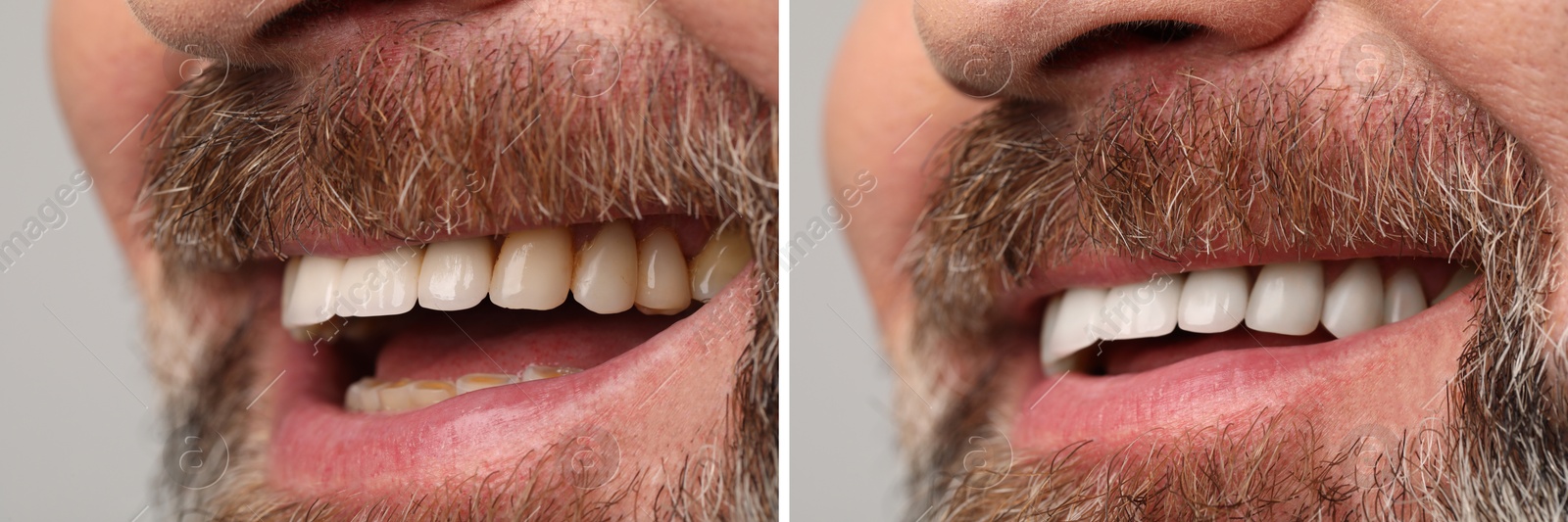 Image of Man smiling before and after procedure dental veneers placement on grey background, closeup. Aesthetic improvement of teeth, collage