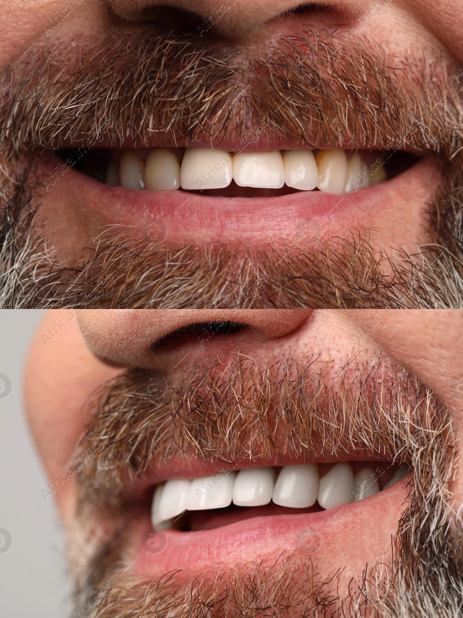 Image of Man smiling before and after procedure dental veneers placement, closeup. Aesthetic improvement of teeth, collage