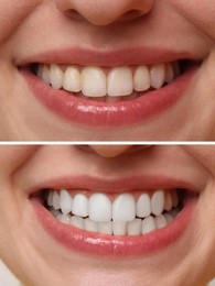 Image of Woman smiling before and after procedure dental veneers placement, closeup. Aesthetic improvement of teeth, collage