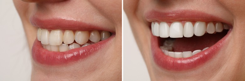 Image of Woman smiling before and after procedure dental veneers placement on white background, closeup. Aesthetic improvement of teeth, collage