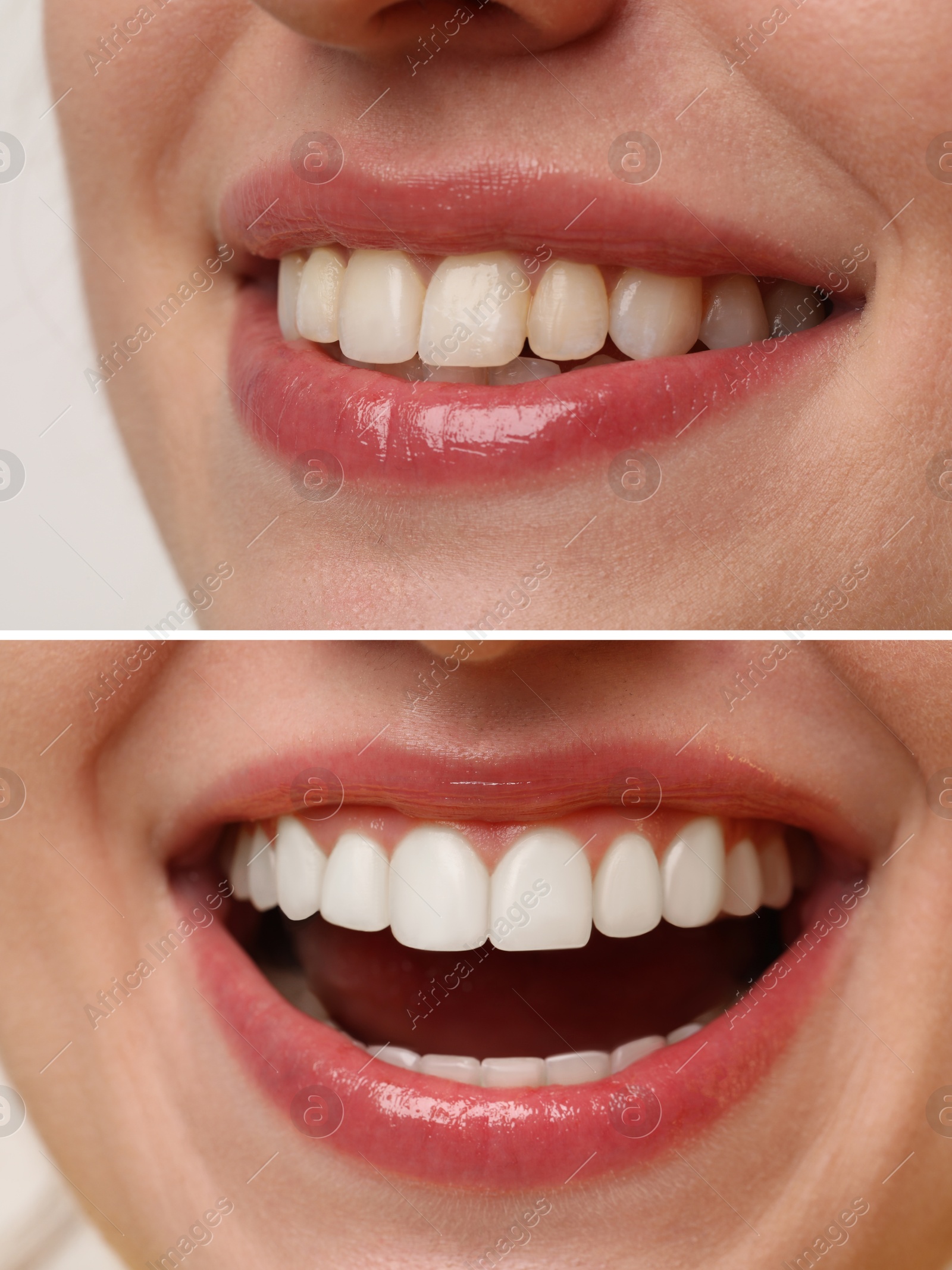 Image of Woman smiling before and after procedure dental veneers placement, closeup. Aesthetic improvement of teeth, collage