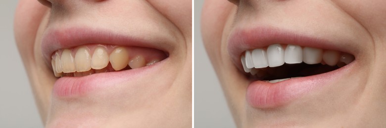 Image of Woman smiling before and after procedure dental veneers placement on grey background, closeup. Aesthetic improvement of teeth, collage