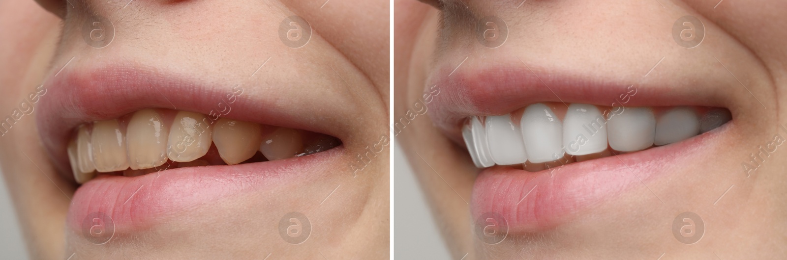 Image of Woman smiling before and after procedure dental veneers placement, closeup. Aesthetic improvement of teeth, collage