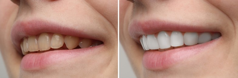 Image of Woman smiling before and after procedure dental veneers placement, closeup. Aesthetic improvement of teeth, collage