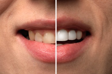 Image of Woman smiling before and after procedure dental veneers placement, closeup. Aesthetic improvement of teeth, collage