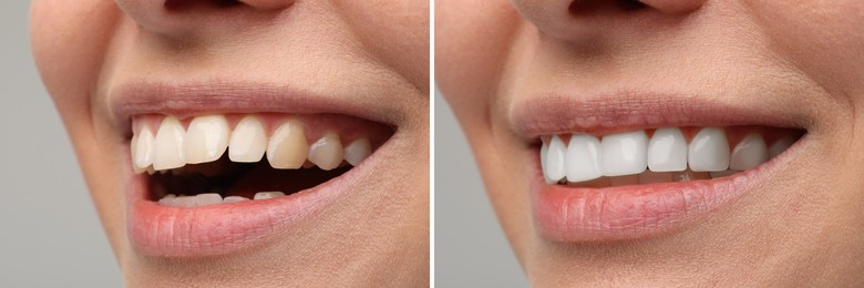 Image of Woman smiling before and after procedure dental veneers placement on grey background, closeup. Aesthetic improvement of teeth, collage