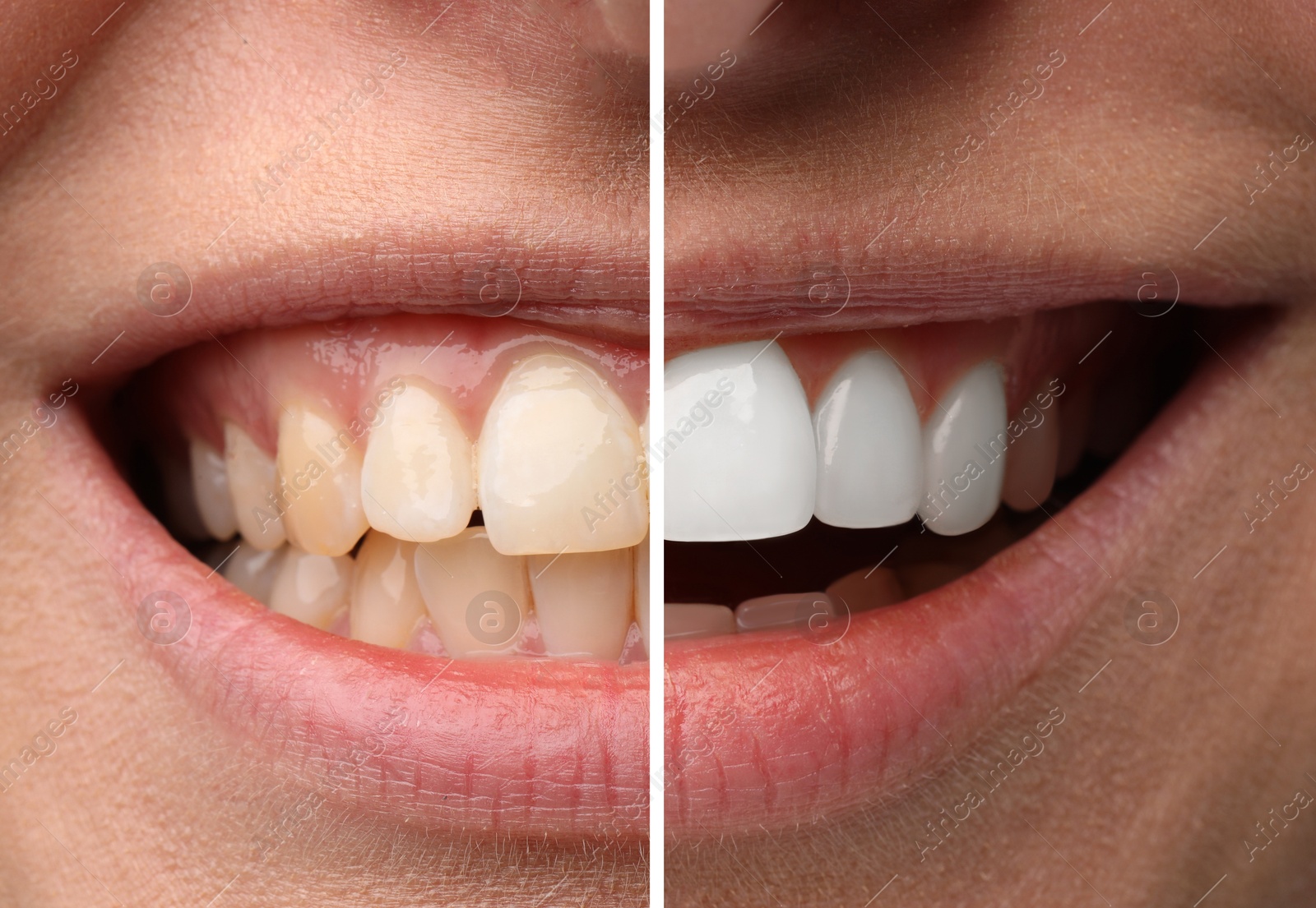 Image of Woman smiling before and after procedure dental veneers placement, closeup. Aesthetic improvement of teeth, collage