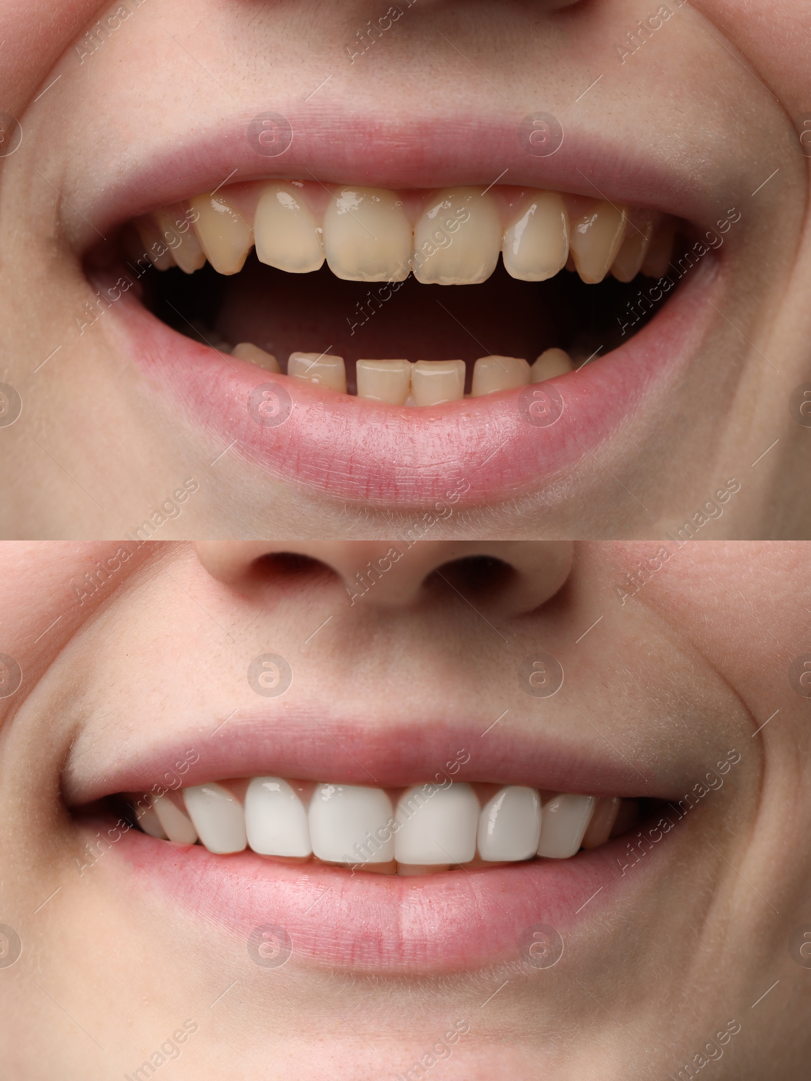 Image of Woman smiling before and after procedure dental veneers placement, closeup. Aesthetic improvement of teeth, collage