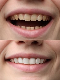 Image of Woman smiling before and after procedure dental veneers placement, closeup. Aesthetic improvement of teeth, collage