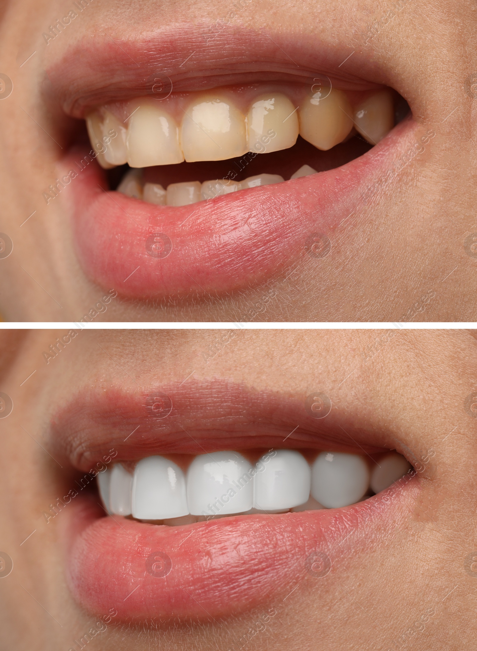 Image of Woman smiling before and after procedure dental veneers placement, closeup. Aesthetic improvement of teeth, collage