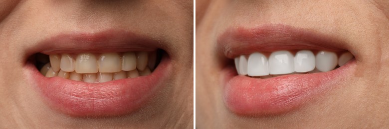 Image of Woman smiling before and after procedure dental veneers placement, closeup. Aesthetic improvement of teeth, collage