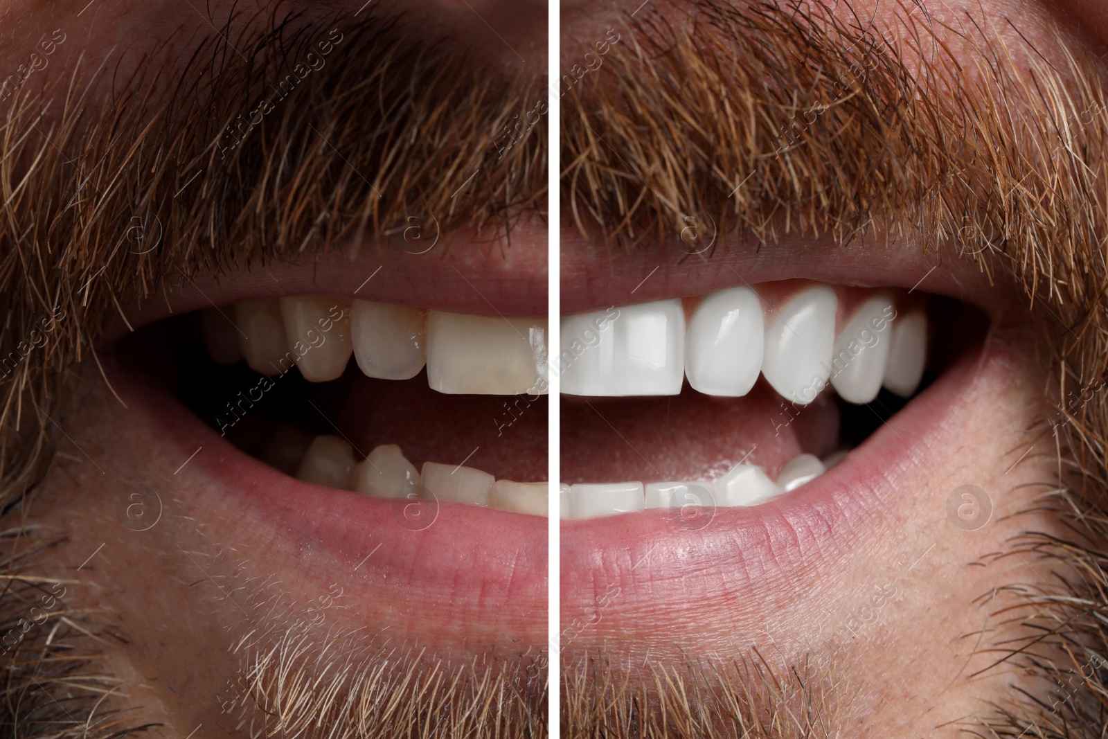 Image of Man smiling before and after procedure dental veneers placement, closeup. Aesthetic improvement of teeth, collage